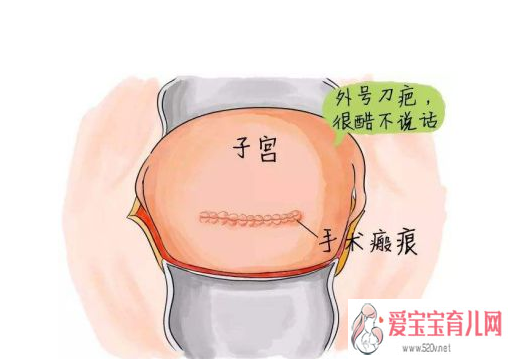 疤痕子宫再次怀孕有什么风险疤痕子宫怀孕注意事项